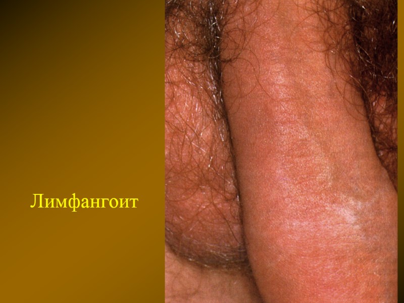 Лимфангоит